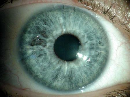 une lentille intracornenne implante
